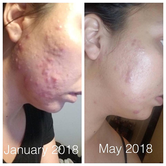 Momentum's Super Acne Fighter / Organic Acne Treatment / Acne