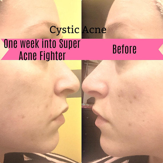 Momentum's Super Acne Fighter / Organic Acne Treatment / Acne